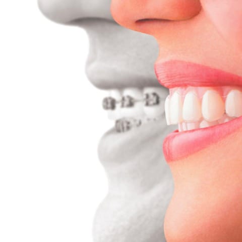 Apparecchio dentale a Roma Montesacro